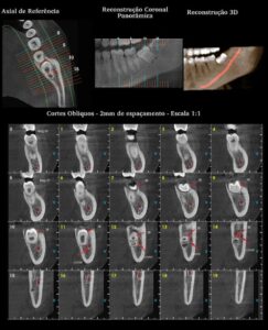 Tomografia Cone Beam Digital Dente Sp